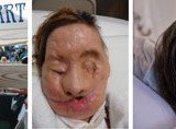 Charla Nash face transplant three views