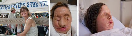 Charla Nash face transplant three views