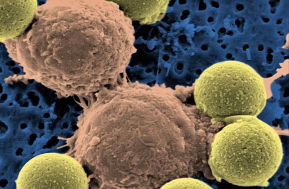 "Microscopic image showing two T cells binding to beads, depicted in yellow, that cause the cells to divide. After the beads are removed, the T cells are infused into cancer patients." (Dr. Carl June / Pennsylvania Medicine)