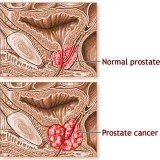 Researchers from Lund University have identified a method that may attack and destroy prostate cancer stem cells