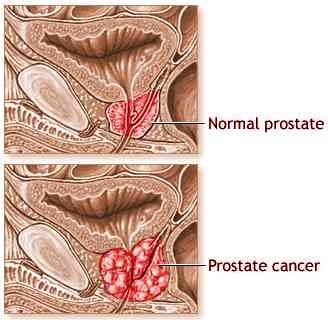 Researchers from Lund University have identified a method that may attack and destroy prostate cancer stem cells
