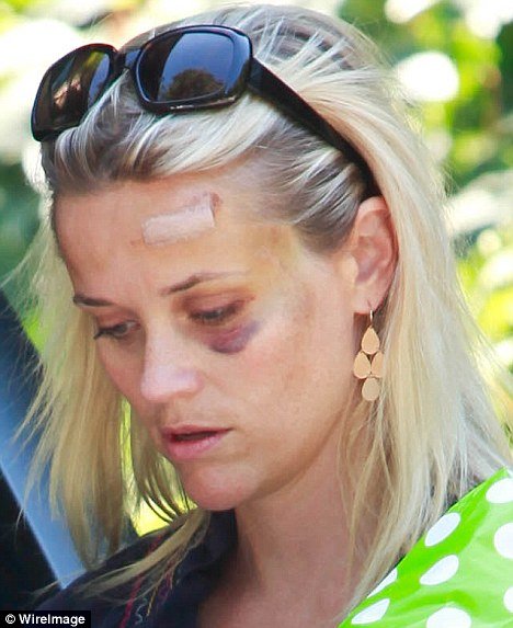 Reese Witherspoon has a black eye after she was hit by a car last week