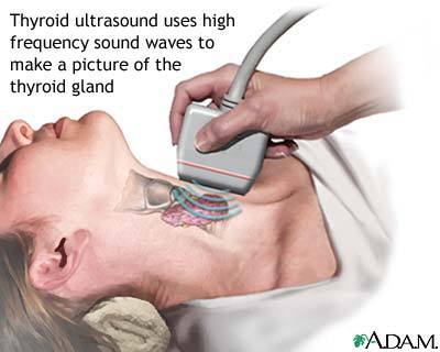 Thyroid ultrasound confirms the presence of the nodules. Less than 5 percent of thyroid nodules are malignant.
