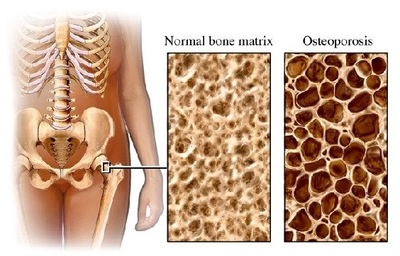 Osteoporosis occurs when bone mineral density is lower. The bones are fragile and break (fracture) easily.