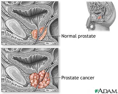 PSA test should not be a routine in preventing prostate cancer, says US Preventive Services Task Force