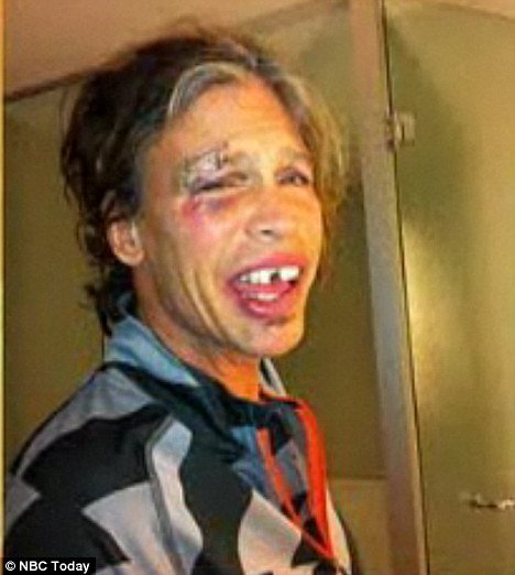 Steven Tyler revealed on The Today Show an image of himself taken shortly after the fall in which he sported broken teeth and a nasty black eye