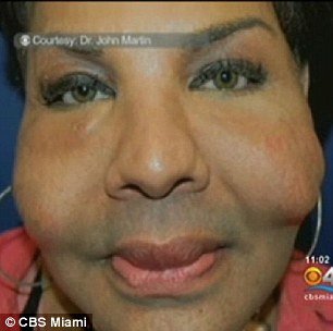 Rajee Narinesingh, an alleged victim of “butt implant doctor” Oneal Ron Morris has come forward to show the horrific state of her face after it was injected with a toxic mixture of cement and tire sealant