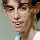 Kate Chilver, 31, weighed 30 kg (66 lb) and was so thin that parts of her stomach and bowel had “died” through lack of blood supply