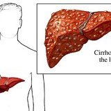 Chronic hepatitis C might lead to liver cirrhosis.