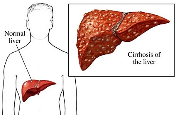 Chronic hepatitis C might lead to liver cirrhosis.
