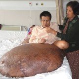 Nguyen Duy Hai from Vietnam has come through a 12-hour operation to remove a 198 lb tumour from his right leg