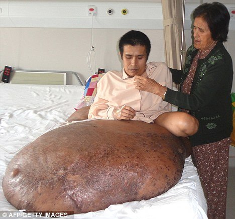Nguyen Duy Hai from Vietnam has come through a 12-hour operation to remove a 198 lb tumour from his right leg