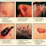 Detecting melanoma cells when they start to spread into the blood stream, might be a way to improve treatment and prevention.