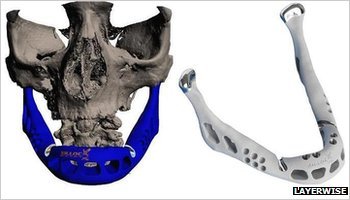 A lower jaw created by LayerWise 3D printer has been fitted to an 83-year-old woman's face in what doctors say is the first transplant of its kind