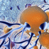 Alzheimer’s plaques (in brown) form around brain cells (in blue) and shrink parts of the brain