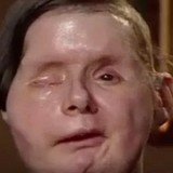 Charla Nash after face transplant