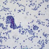 Chemosat and metastatic liver cancer