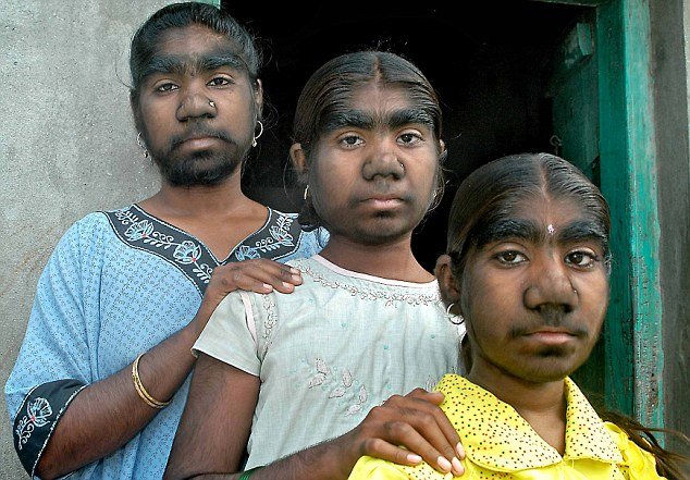 In an incredible quirk of fate, three sisters from a small village near Pune, central India, have all been blighted by a condition known as werewolf syndrome - where they are covered from head to foot in thick hair