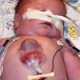 Ryan Marquiss is the first child in the world to survive being born with his heart outside of his body