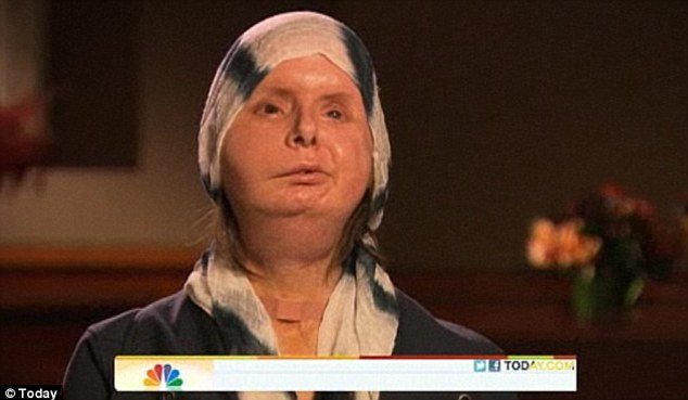 Charla Nash says she feels at home in her new skin two years after her face transplant