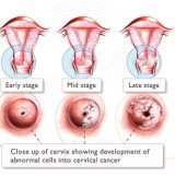 The Swedish study shows a 92 percent cure rate of cervical cancer after a smear test diagnosis, compared with 66 percent for symptoms-based diagnoses