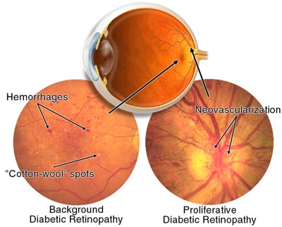 The eye condition the researchers were looking at was retinopathy, which is common in patients with Type 2 diabetes or high blood pressure