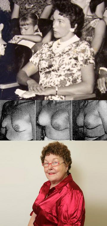 Timmie Jean Lindsey is the first woman who had a breast augmentation with silicone implants in 1962 at Jefferson Davis hospital in Houston