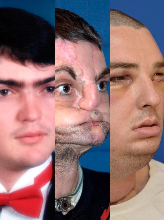 US doctors at the University of Maryland gave Richard Norris a new face, including jaw, teeth and tongue, in an operation that is the most extensive face transplant ever performed