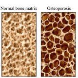 NASA scientists have discovered a new technique to detect osteoporosis bone loss at the earliest disease stages