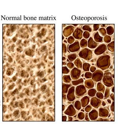 NASA scientists have discovered a new technique to detect osteoporosis bone loss at the earliest disease stages