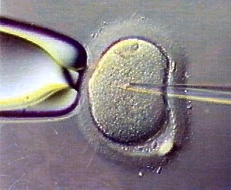 Research on more than 300,000 babies found those born using Intracytoplasmic sperm injection (ICSI) had a significantly higher risk of developing abnormalities than those conceived naturally