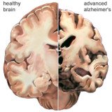Researchers at the University of Leicester uncovered how the build-up of proteins in mice with prion disease resulted in brain cells dying