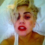 Lady Gaga has taken to Twitter to post up a photo of herself with her black eye which was caused by the Auckland concert incident