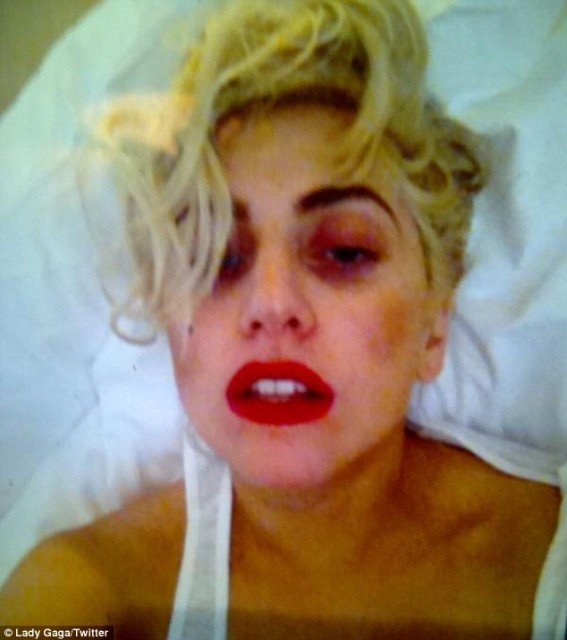 Lady Gaga has taken to Twitter to post up a photo of herself with her black eye which was caused by the Auckland concert incident