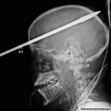 Yasser Lopez, a teenager from Florida, has miraculously survived after a spear was shot through his brain, doctors say
