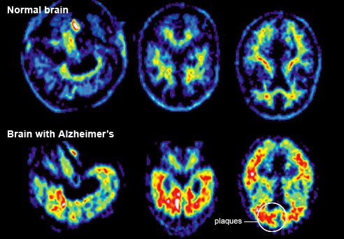 A team at Washington University School of Medicine has assembled a "timeline" of the unseen progress of Alzheimer's before symptoms appear