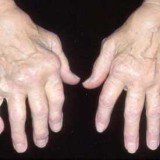 British scientists have discovered another eight pieces of genetic code linked to osteoarthritis, bringing the total number to 11