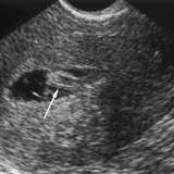 A team of doctors claim that "super-fertility" may explain why some women have multiple miscarriages