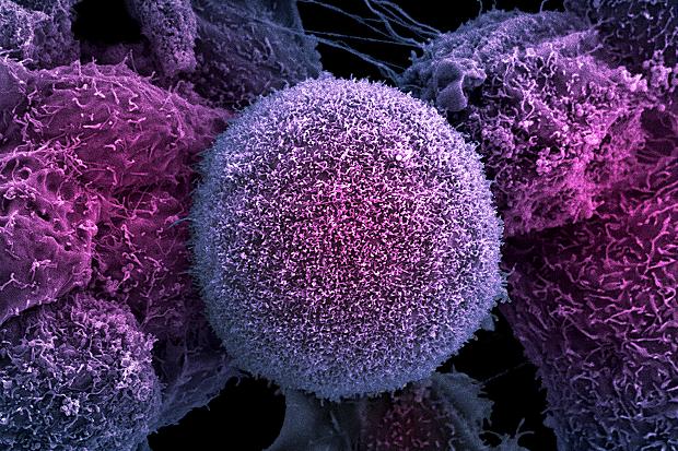 Experts have found that a blood test that reads genetic results like a barcode can pick out the most aggressive prostate cancers