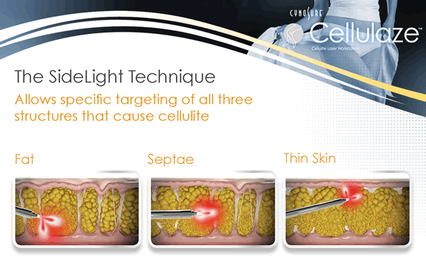 Cellulaze is the first scientifically validated laser cellulite treatment approved by FDA