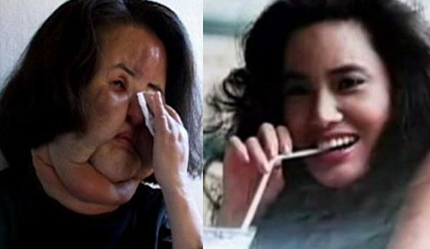 Former Korean model Hang Mioku, a plastic surgery addict, injected cooking oil into her face when doctors refused to give her any more silicone