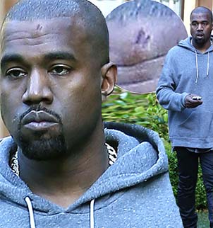 Kanye West hit his head on a caution sign on Friday while on a lunch date with Kim Kardashian