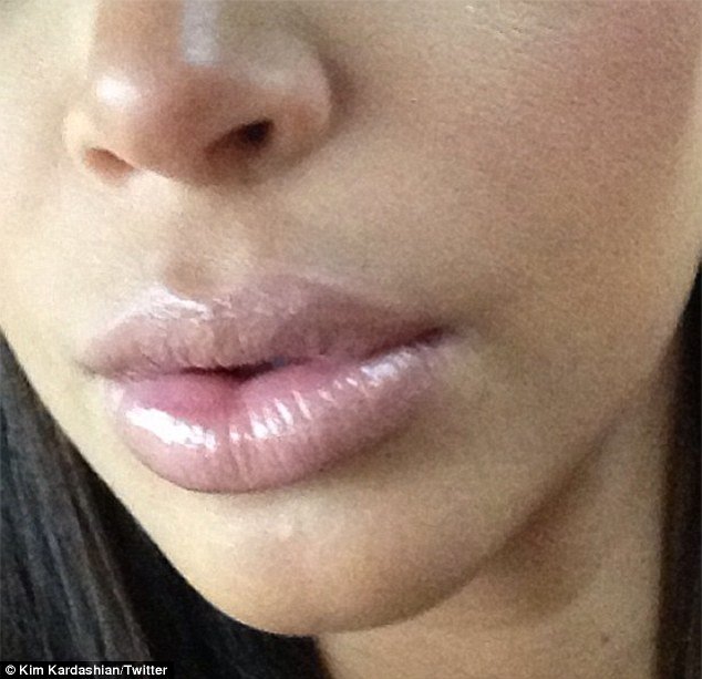 Kim Kardashian shares a picture of her plumped-up pout