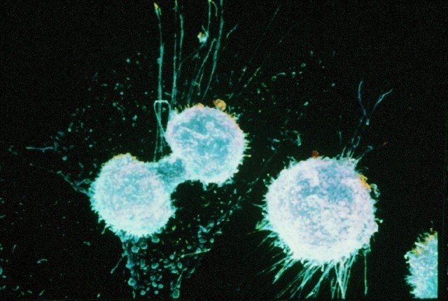 A new way of screening for ovarian cancer is showing potential