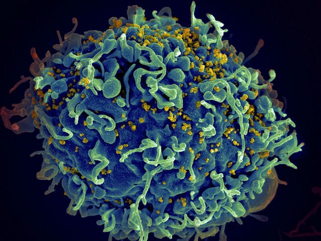 Early HIV treatment may not cure the virus as it can rapidly form invulnerable strongholds in the body