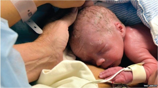 The baby boy’s birth took place in Sweden after surgeons at the University of Gothenburg performed the pioneering transplant procedure