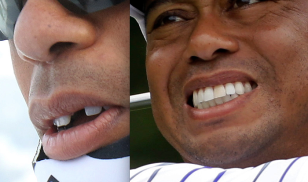 Tiger Woods missing tooth
