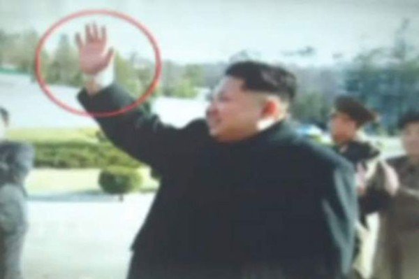 Kim Jong un wrist injury