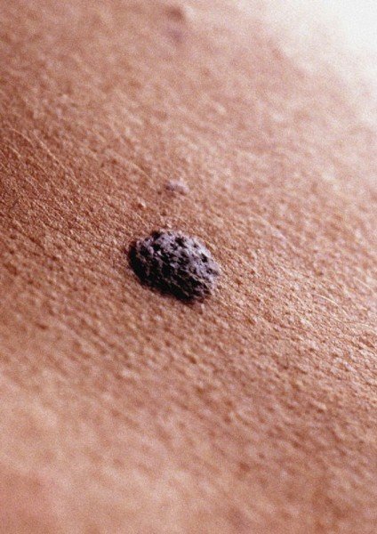 Mole and skin cancer risk